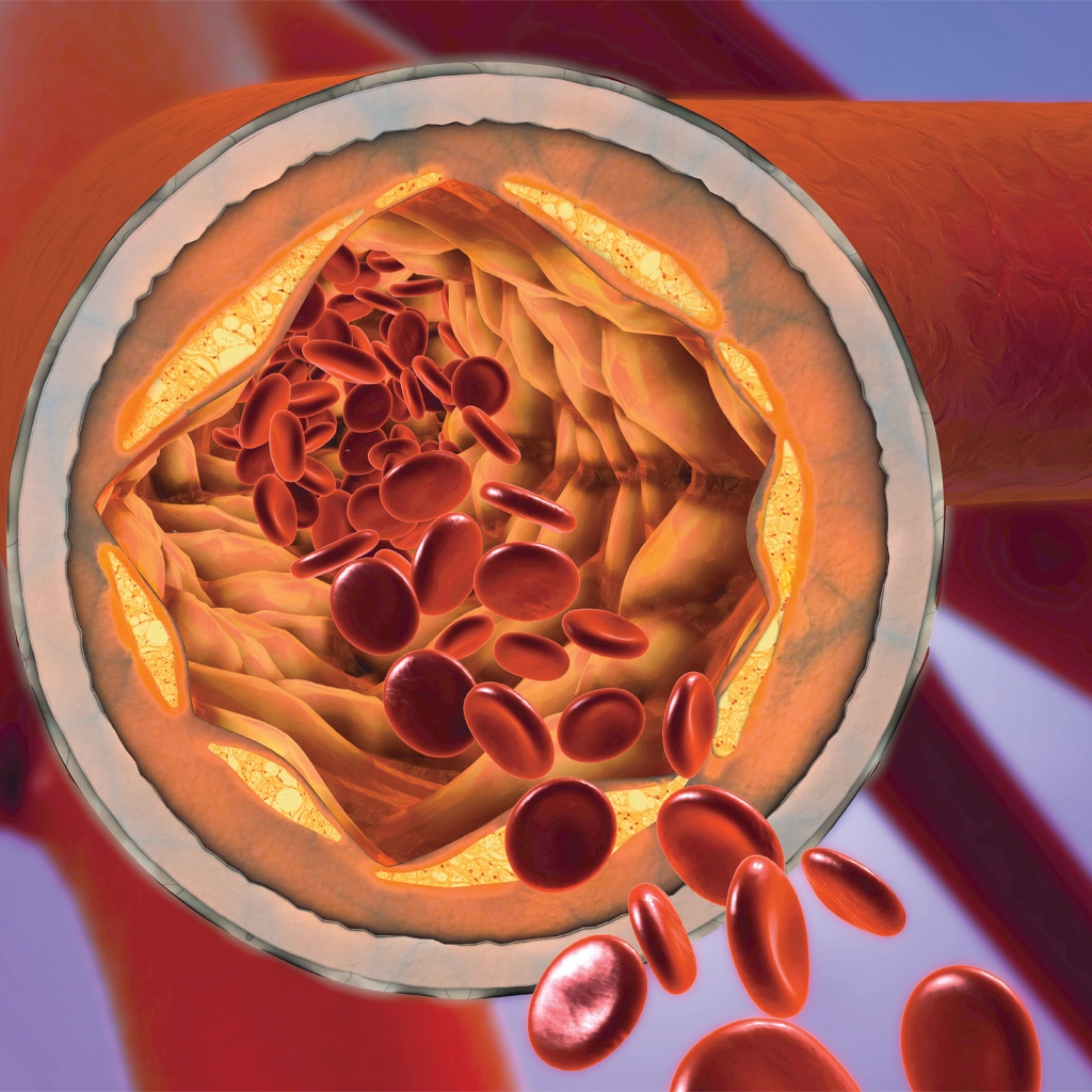 peripheral artery disease