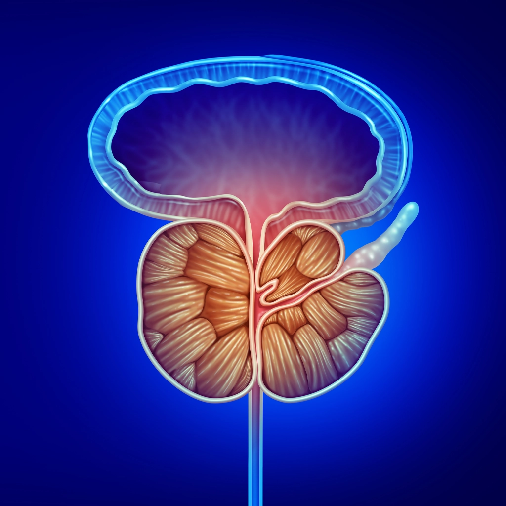 enlarged prostate - bph