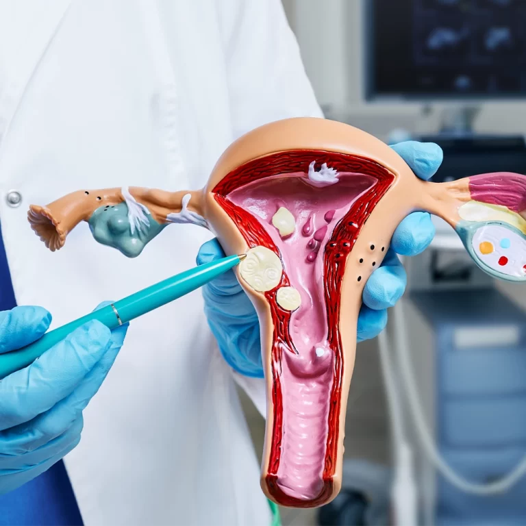 uterine fibroids