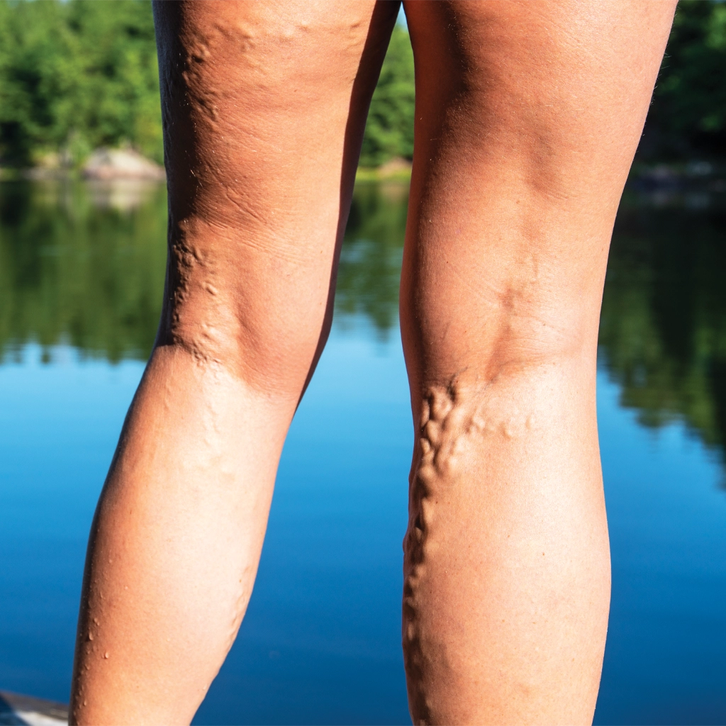 venous disease