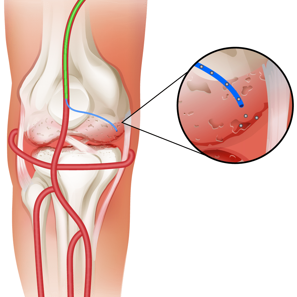 genicular artery embolization (GAE)