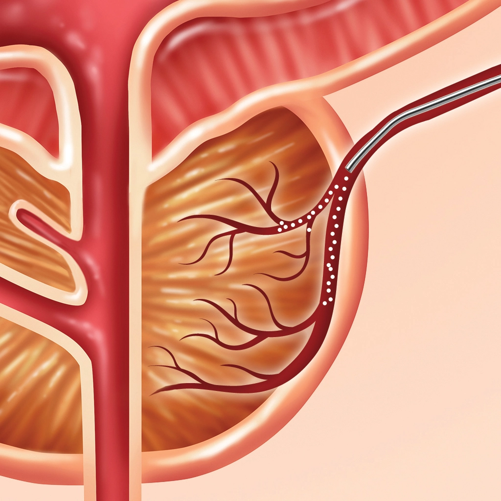 prostate artery embolization