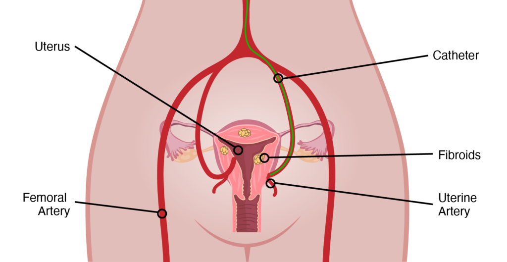 uterine fibroid embolization (UFE)