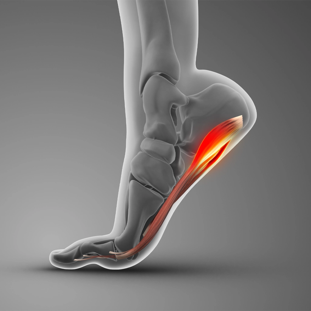 Plantar Fasciitis Embolization