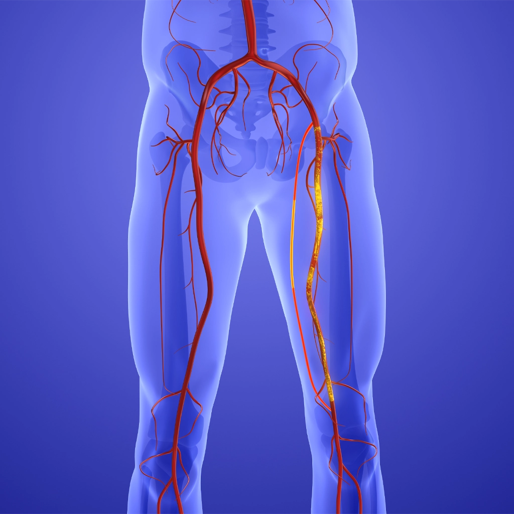 Peripheral Artery Disease Treatment