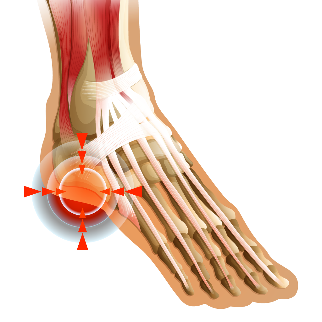 plantar fasciitis