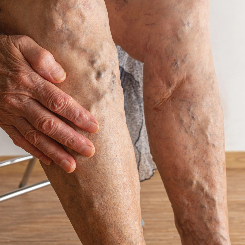 venous disease